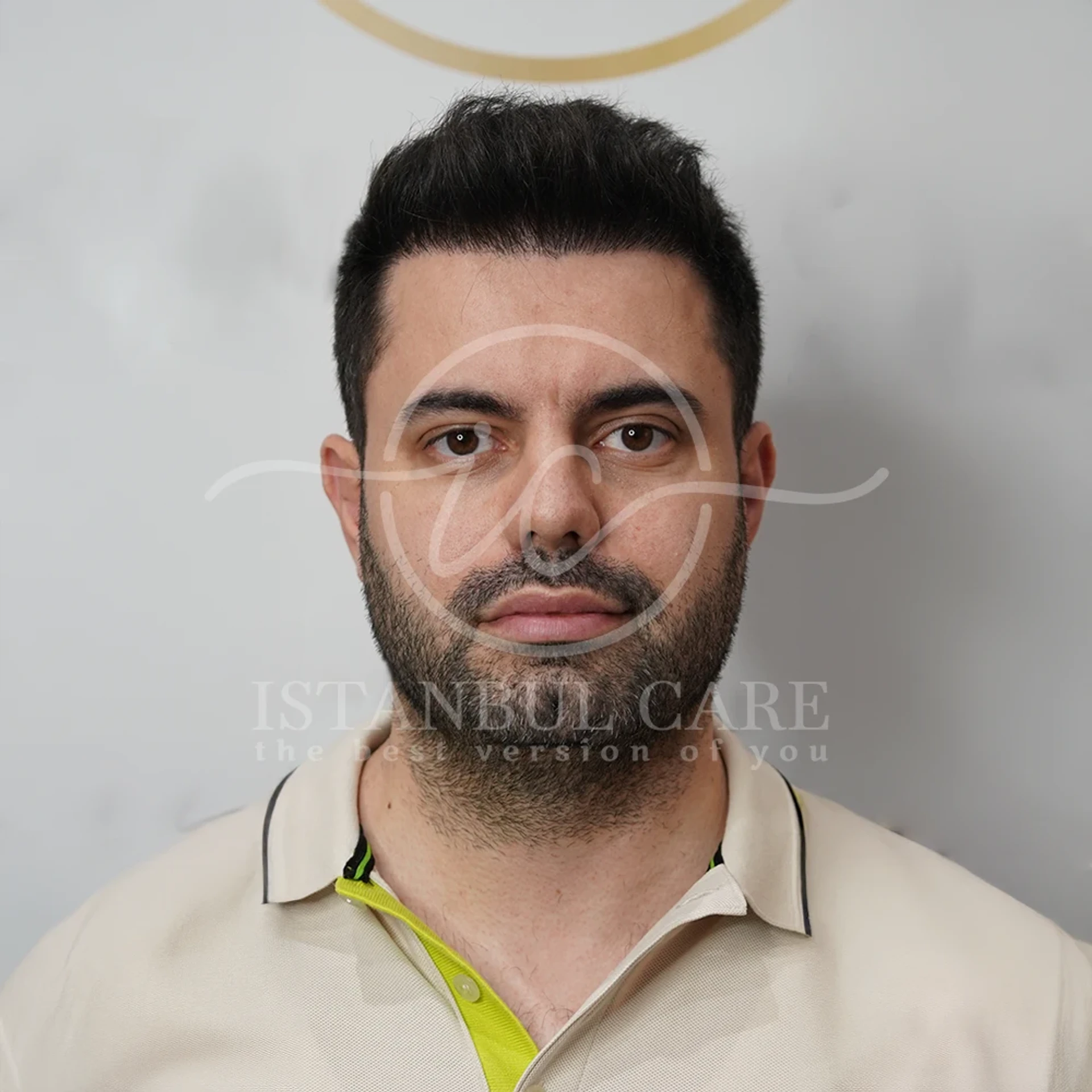 Hair transplant after photo at Istanbul Care — bearded man in a light polo shirt with a restored, dense front hairline, front view