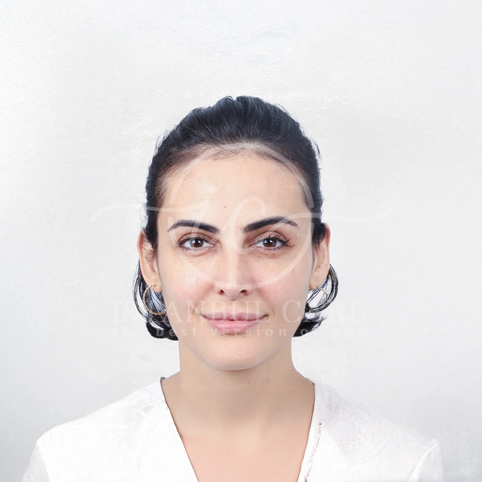 Hair transplant before photo at Istanbul Care — woman with dark hair tied back showing a high hairline and thin temples, front view