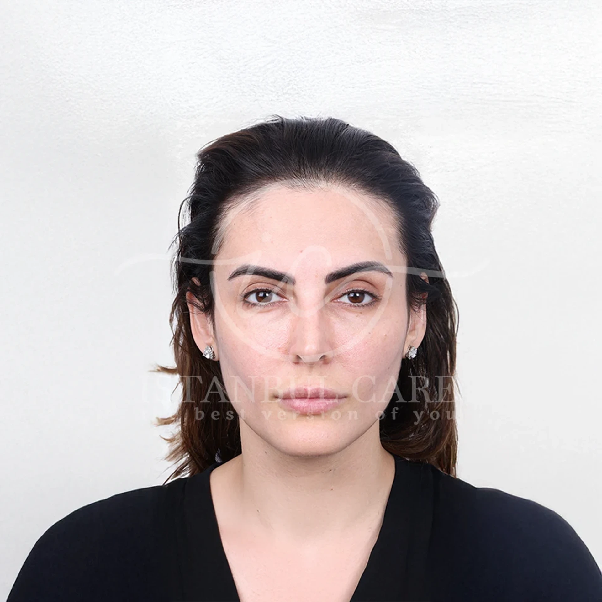 Hair transplant after photo at Istanbul Care — woman with dark hair showing a lowered, fuller front hairline, front view