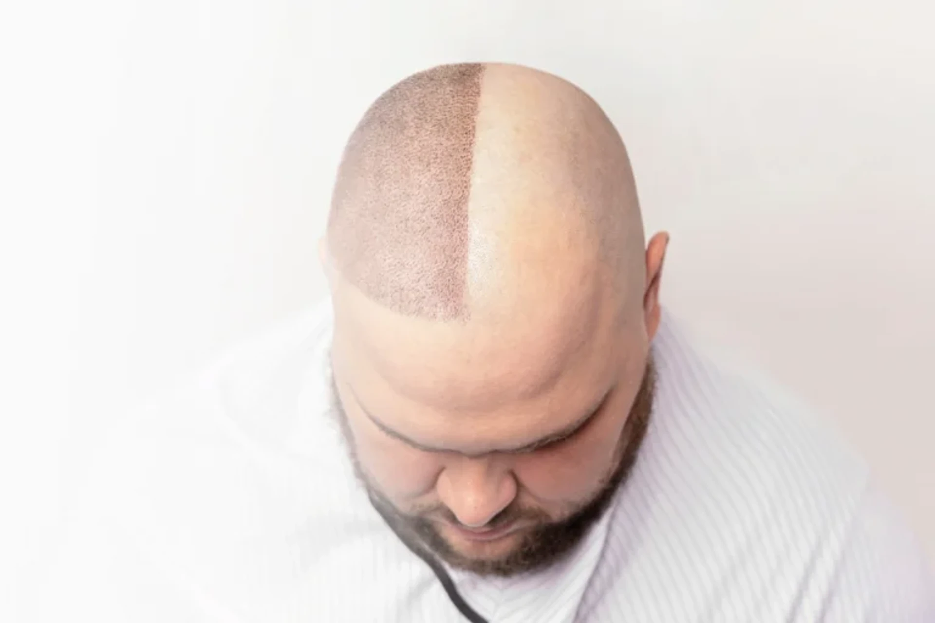 زراعة الشعر بتقنية FUE في تركيا