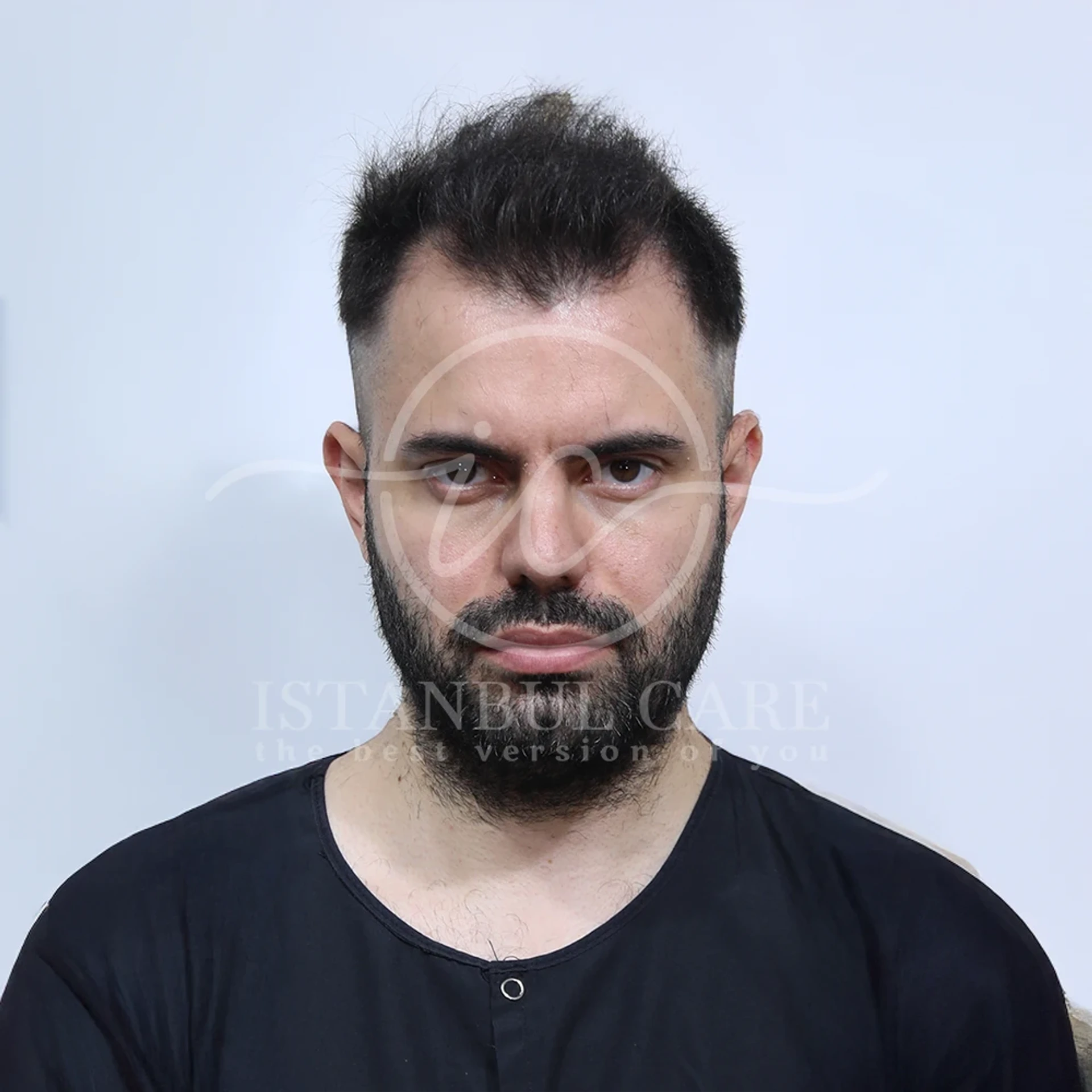Hair transplant before photo at Istanbul Care — bearded man in a dark t-shirt with a receding hairline and thinning temples, front view