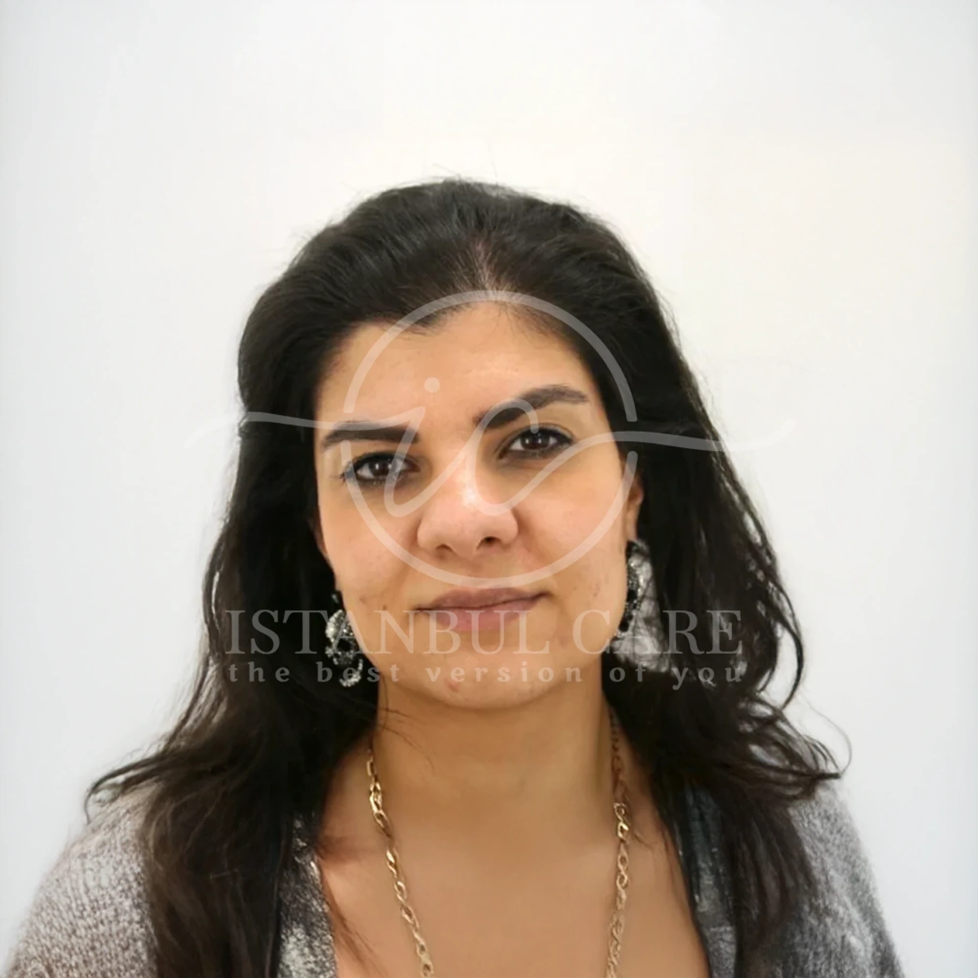 Hair transplant after photo at Istanbul Care — woman with long dark hair showing a fuller, restored front hairline, front view