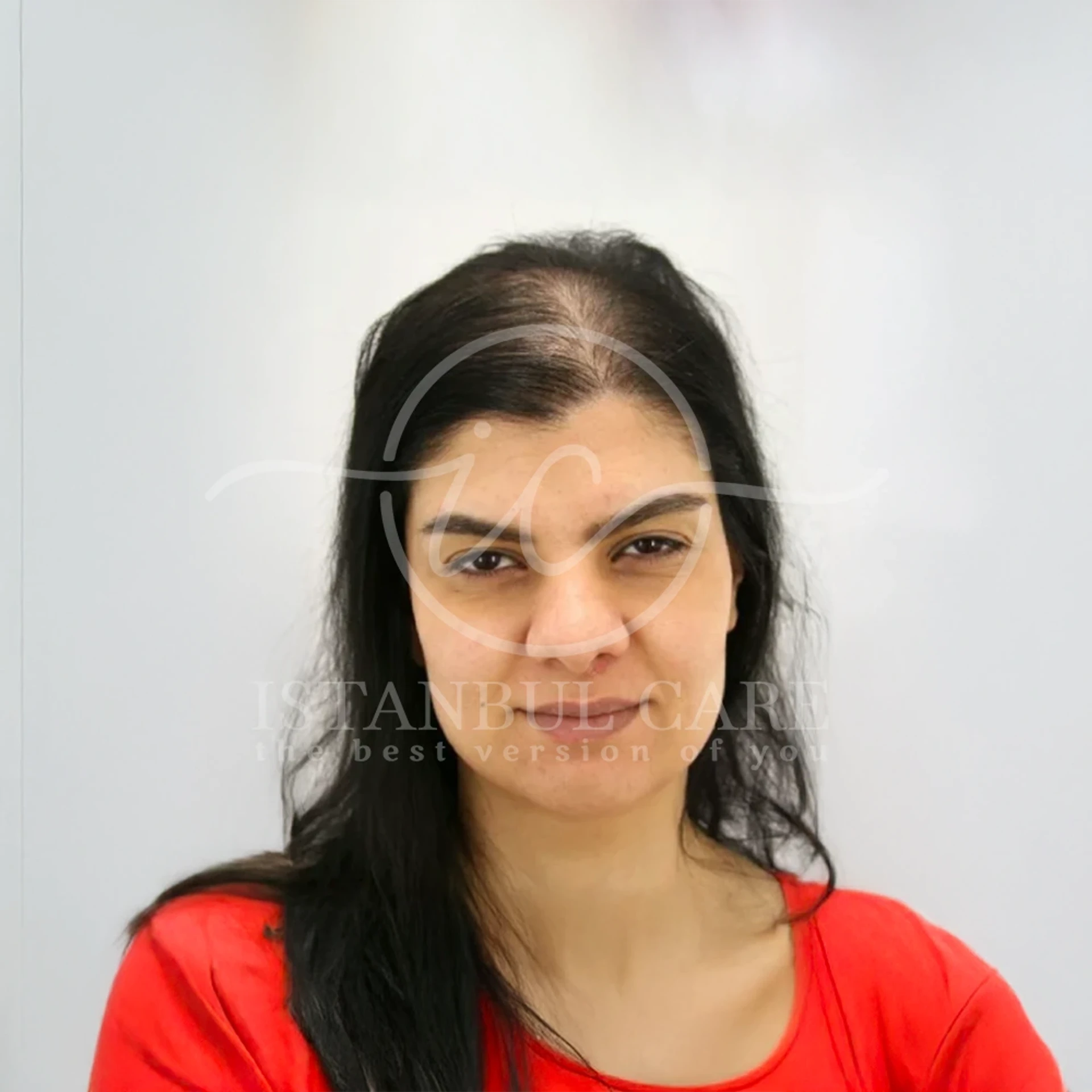 Hair transplant before photo at Istanbul Care — woman in a red top with a thin, receding front hairline, front view