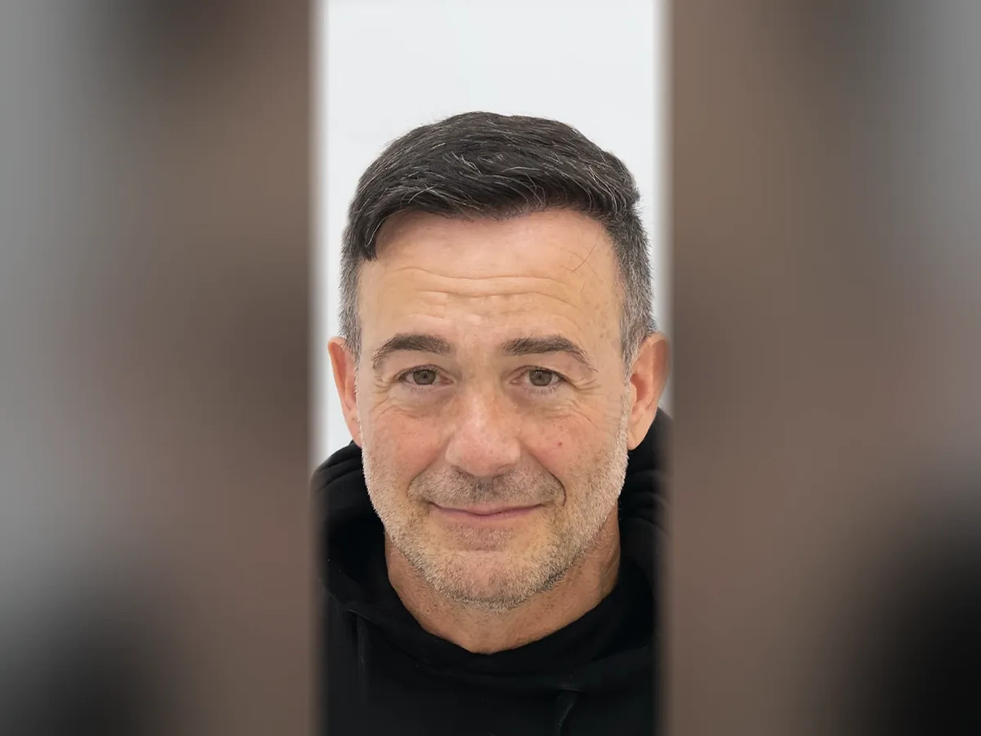 After DHI hair transplant, Istanbul Care patient 01
