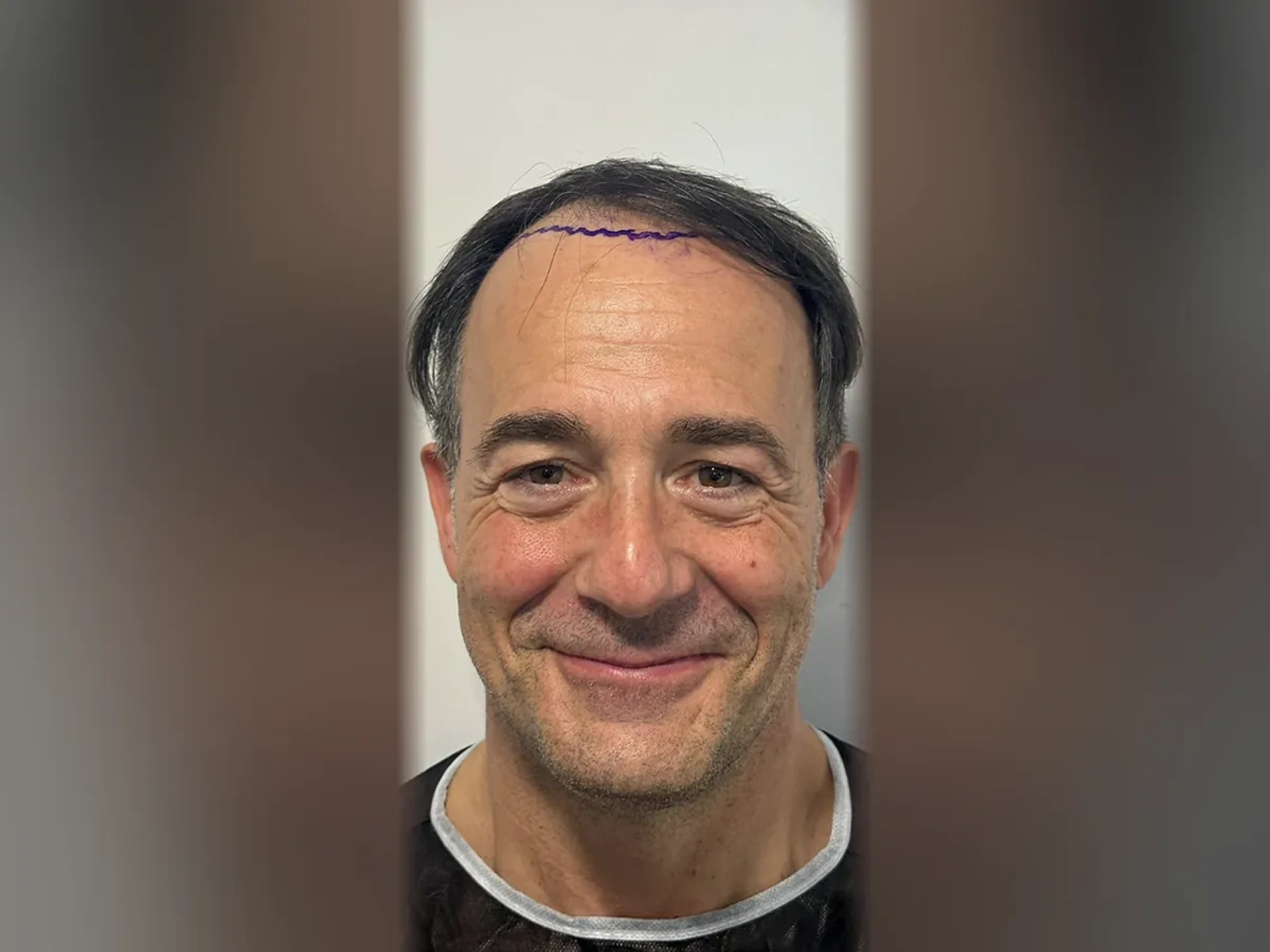 Before DHI hair transplant, Istanbul Care patient 01