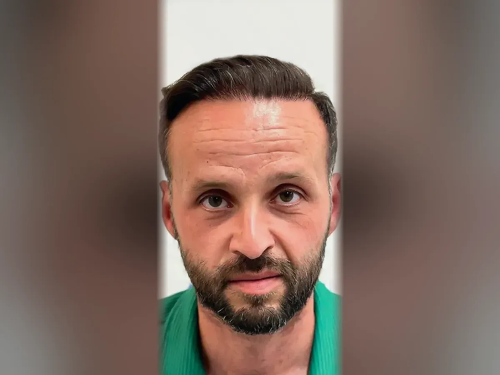 After DHI hair transplant, Istanbul Care patient 02