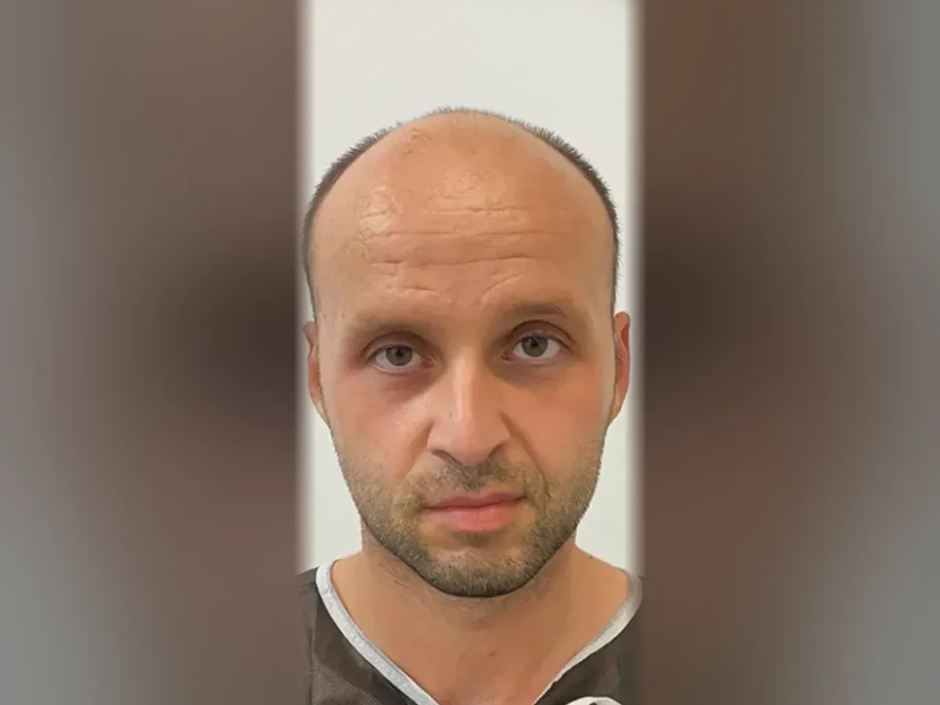 Before DHI hair transplant, Istanbul Care patient 02