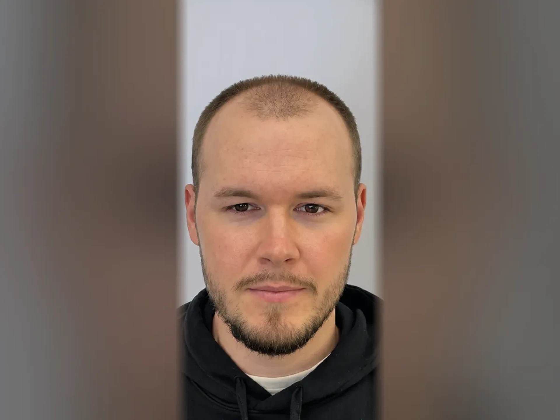Before DHI hair transplant, Istanbul Care patient 03
