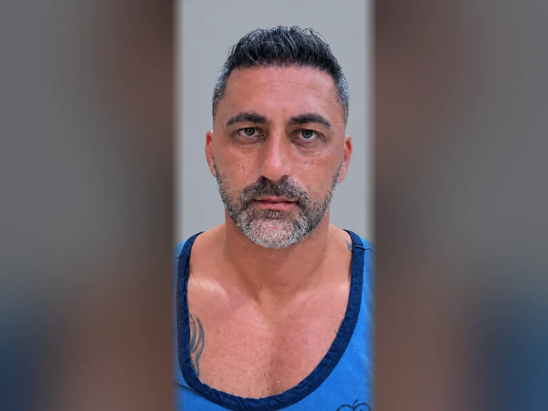 After DHI hair transplant, Istanbul Care patient 04