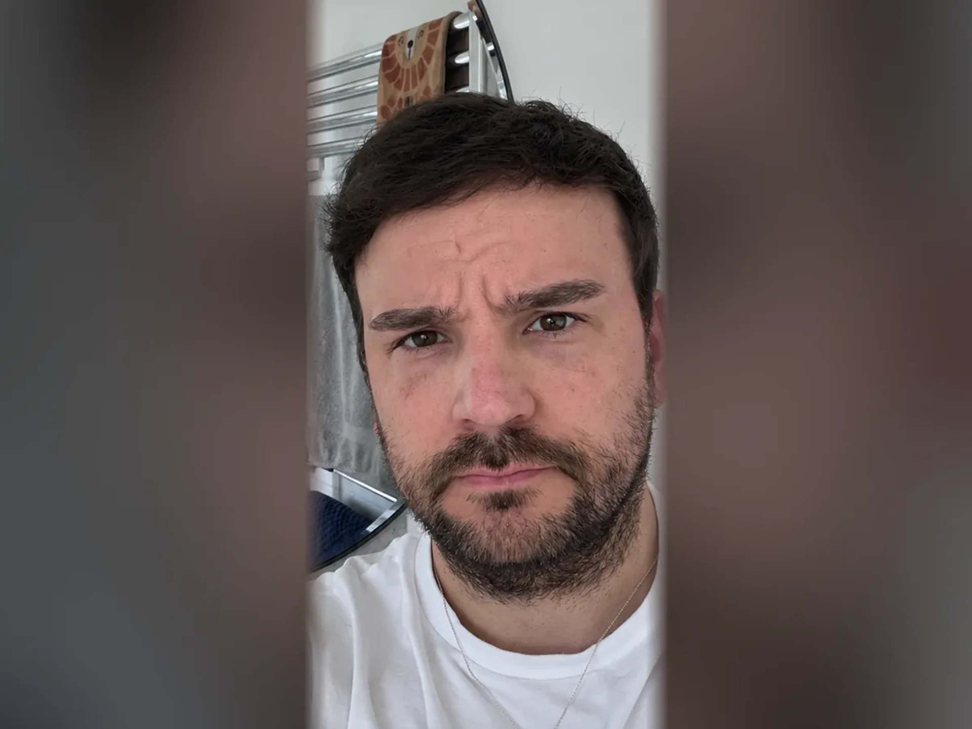 After DHI hair transplant, Istanbul Care patient 05