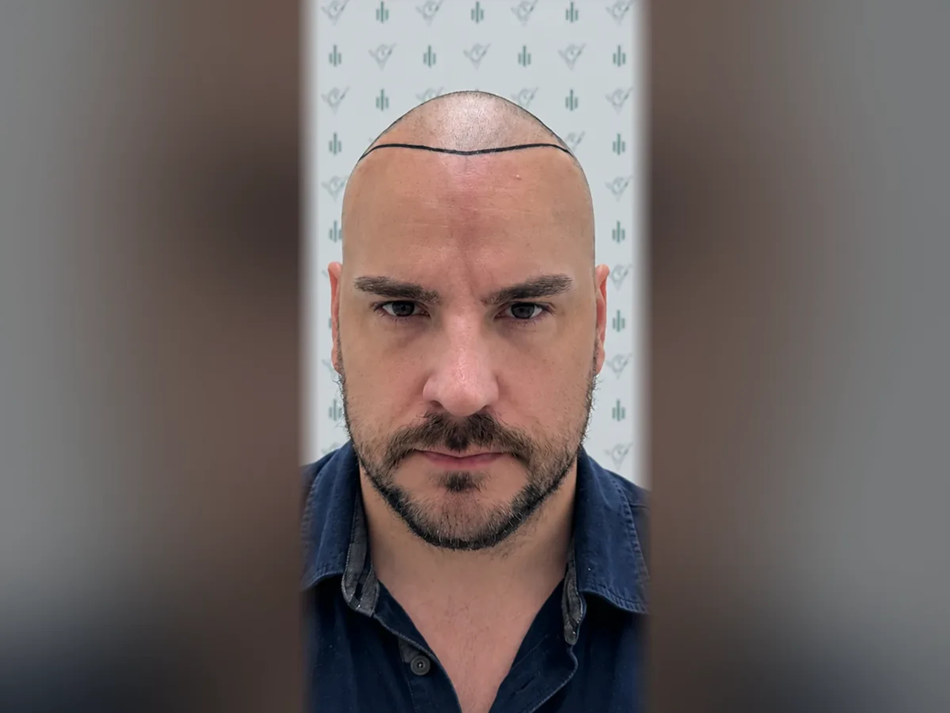 Before DHI hair transplant, Istanbul Care patient 05