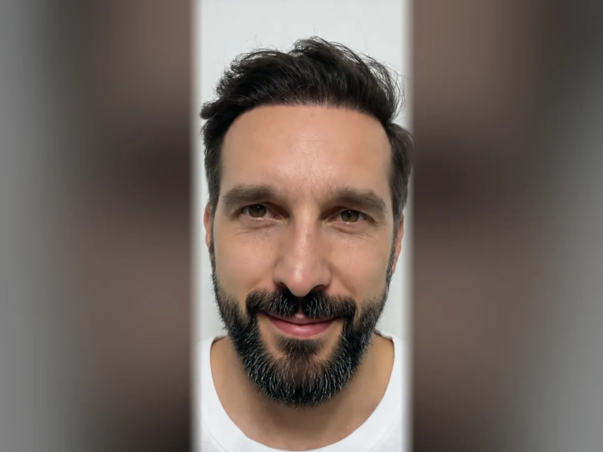 After DHI hair transplant, Istanbul Care patient 06