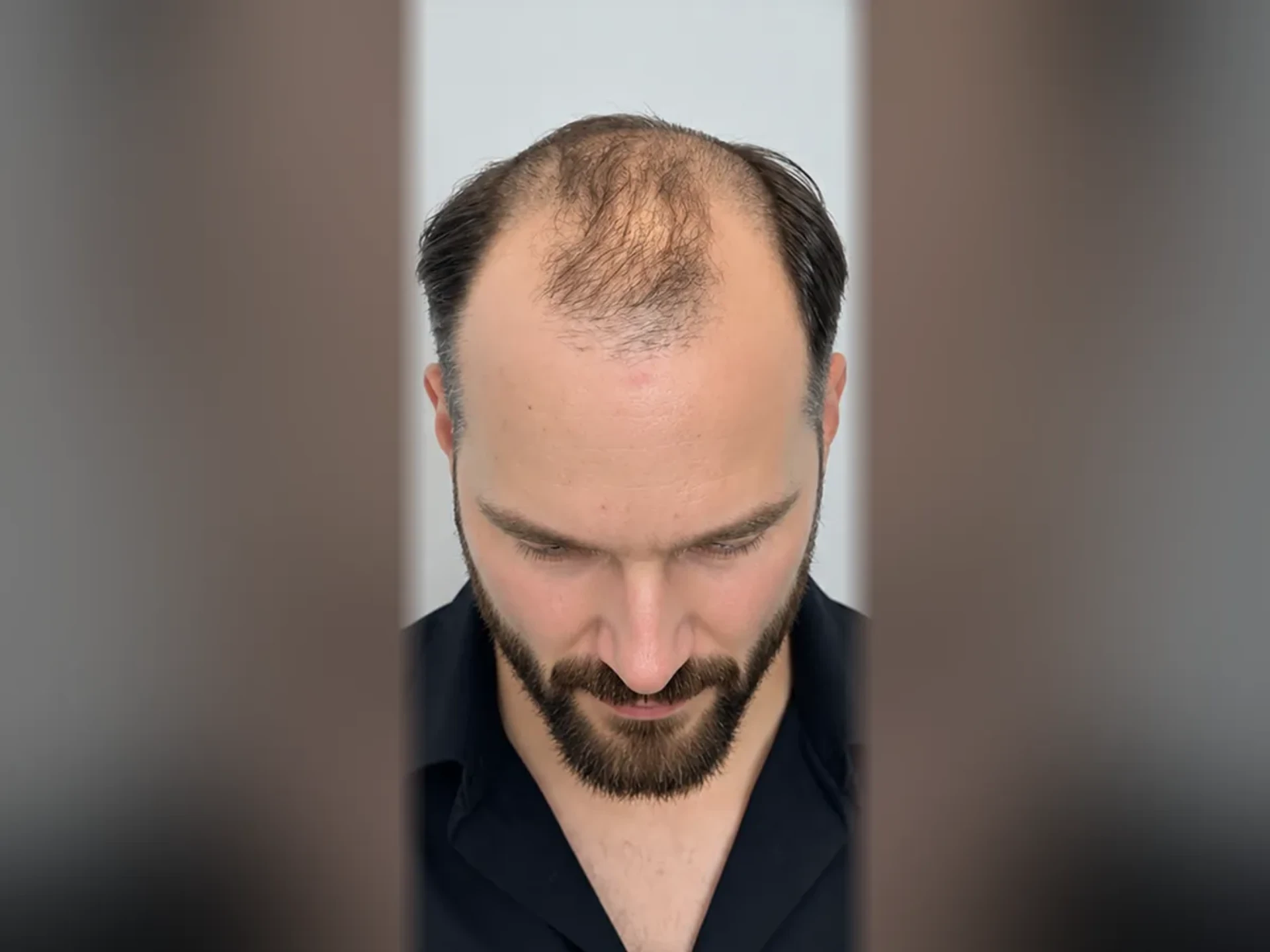 Before DHI hair transplant, Istanbul Care patient 06