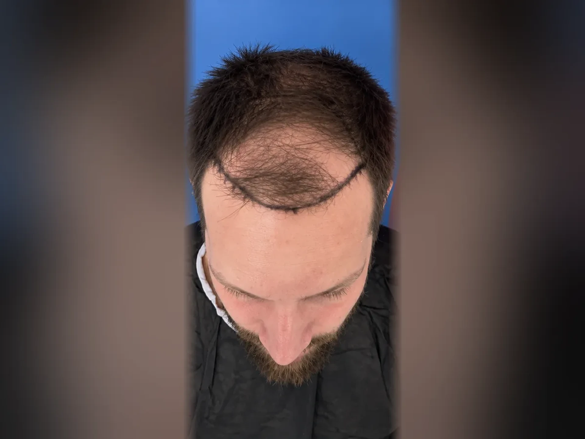 Before DHI hair transplant, Istanbul Care patient 07