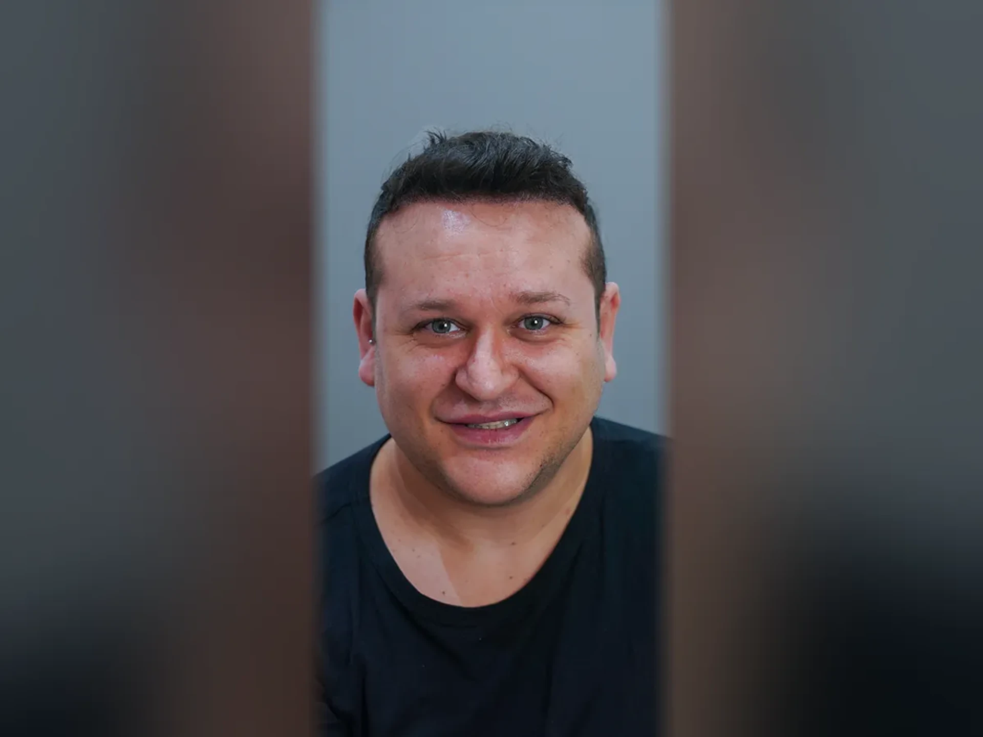 After DHI hair transplant, Istanbul Care patient 08