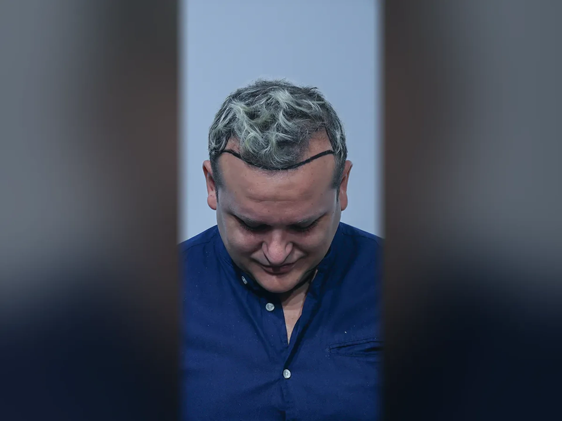 Before DHI hair transplant, Istanbul Care patient 08