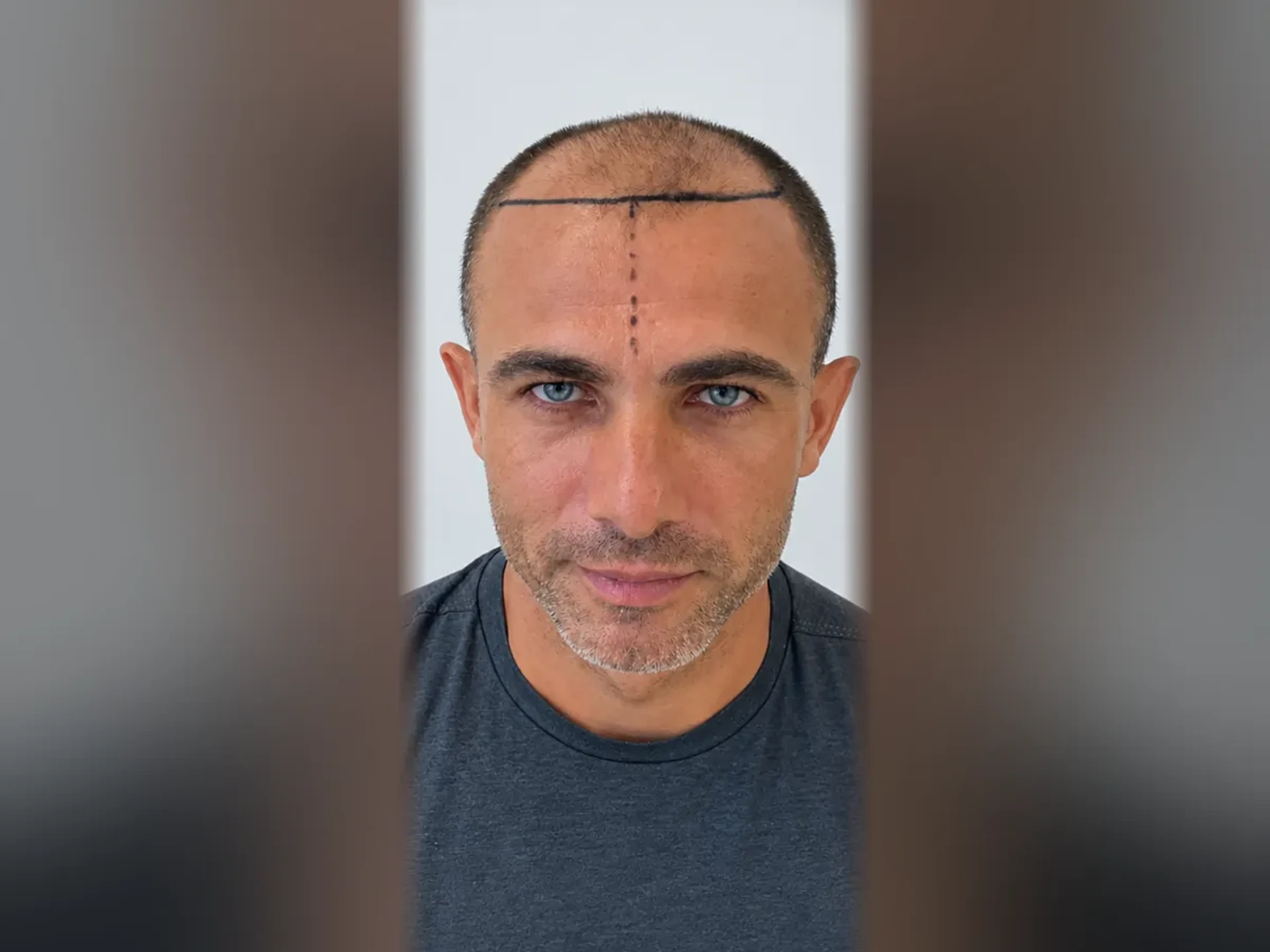 Before DHI hair transplant, Istanbul Care patient 09