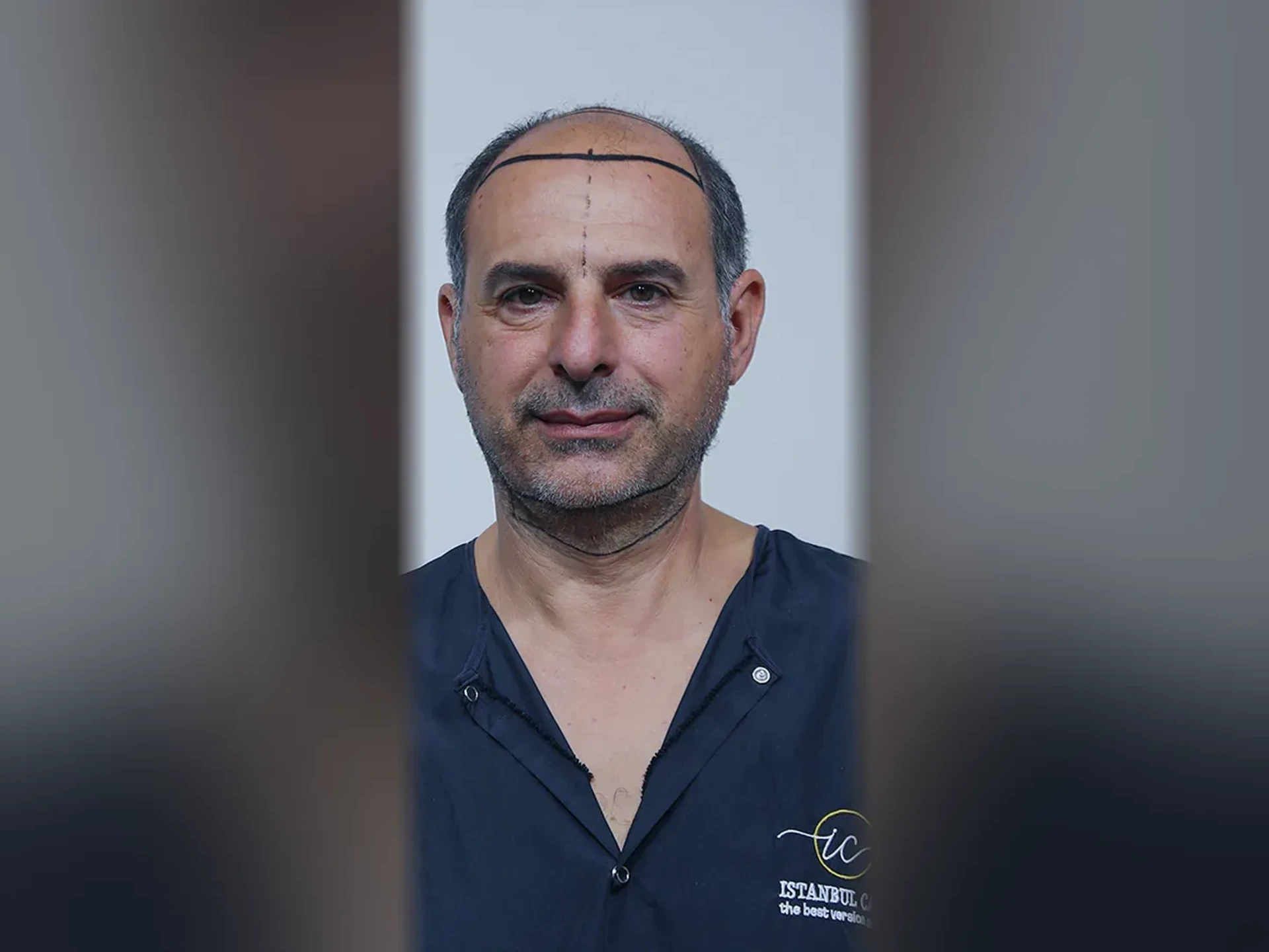 Before DHI hair transplant, Istanbul Care patient 13
