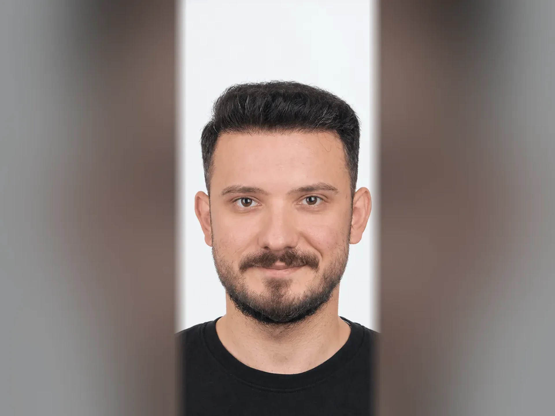 After DHI hair transplant, Istanbul Care patient 14