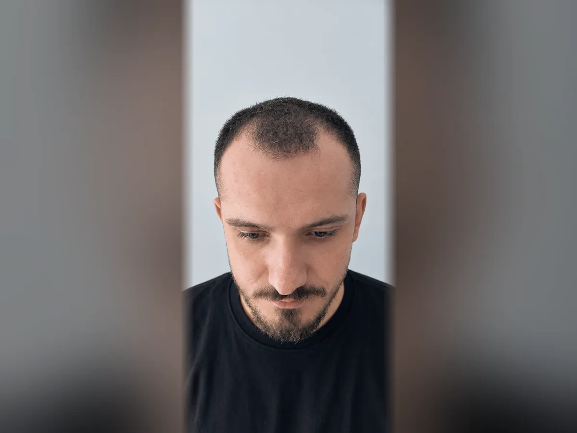 Before DHI hair transplant, Istanbul Care patient 14