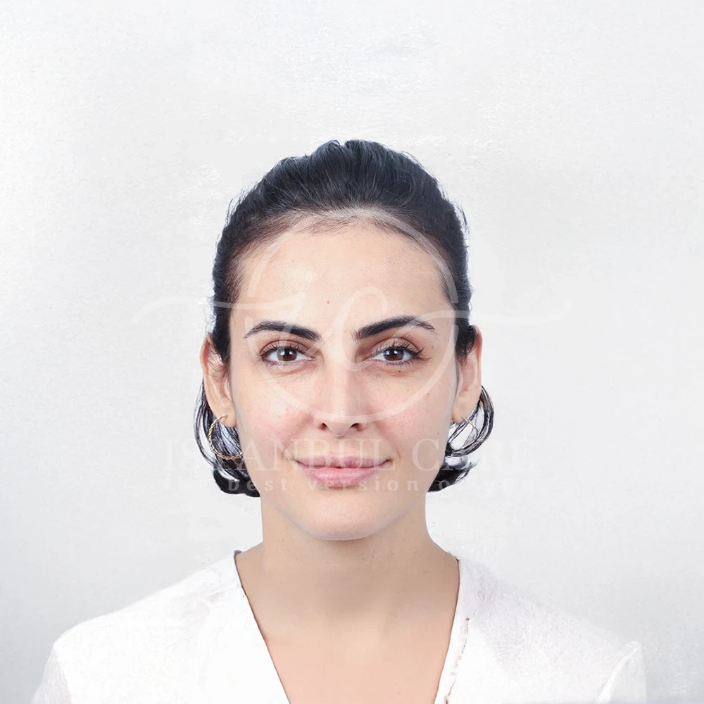 Haartransplantation Vorher-Foto bei Istanbul Care — Frau mit zurückgebundenem dunklem Haar mit hohem Haaransatz und schütteren Schläfen, Frontalansicht
