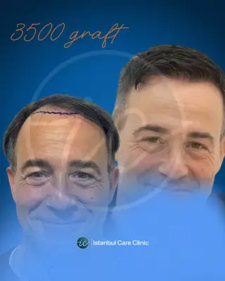 Hair transplant before and after, FUE, 3,500 grafts, 12 months after the procedure