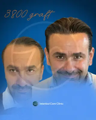 Hair transplant before and after, FUE, 3,800 grafts, 12 months after the procedure