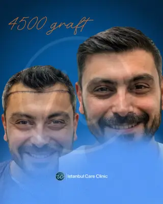 Hair transplant before and after, DHI, 4,500 grafts, 12 months after the procedure