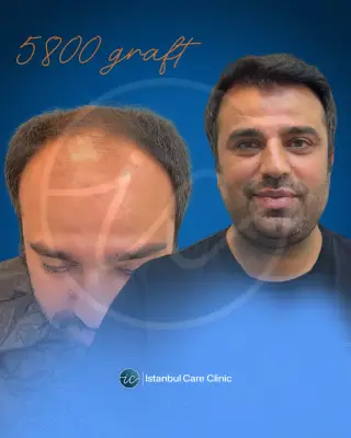 Hair transplant before and after, FUE, 5,800 grafts, 12 months after the procedure