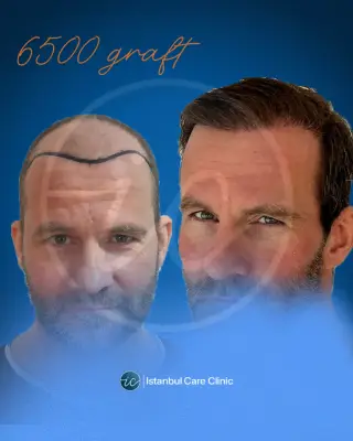 Hair transplant before and after, FUE, 6,500 grafts, 12 months after the procedure