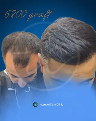 Hair transplant before and after, DHI, 6,800 grafts, 12 months after the procedure