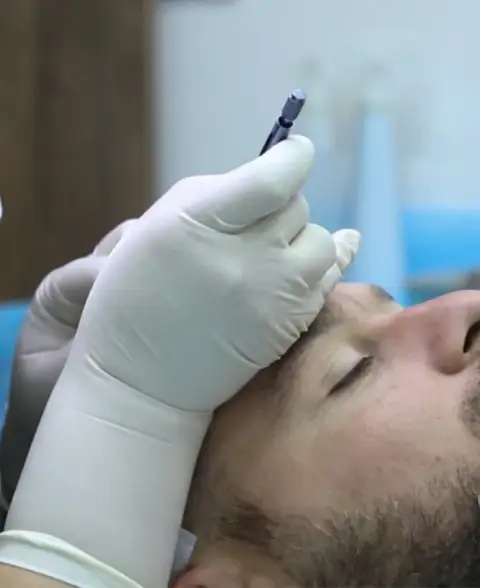 الشفرات الفولاذية في تقنية FUE الكلاسيكية للتخديد