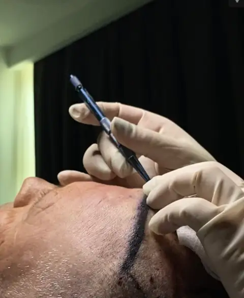 استخدام محركات FUE لاستخراج الطعوم