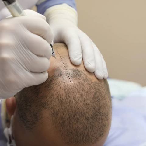 Surgeon marking a hairline before extraction