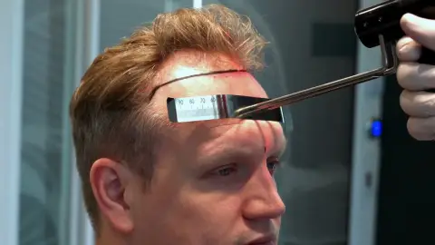 Hairline measured with a caliper at consultation