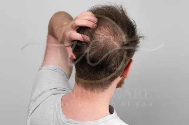 Man showing hair loss at the crown