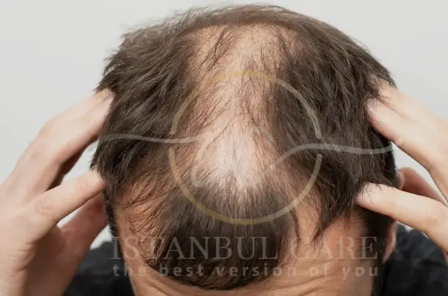 Top-down view of extensive crown hair loss