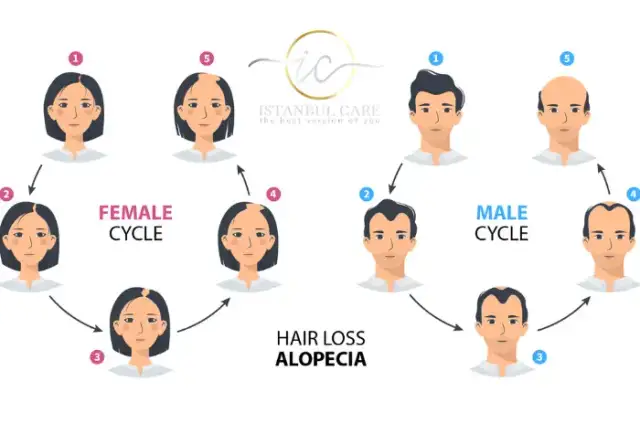 Illustrated diagram of the hair loss stages