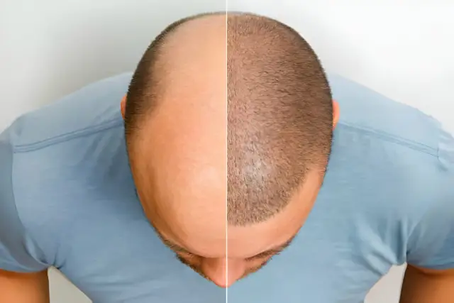Side-by-side before and after comparison of hair loss at the crown