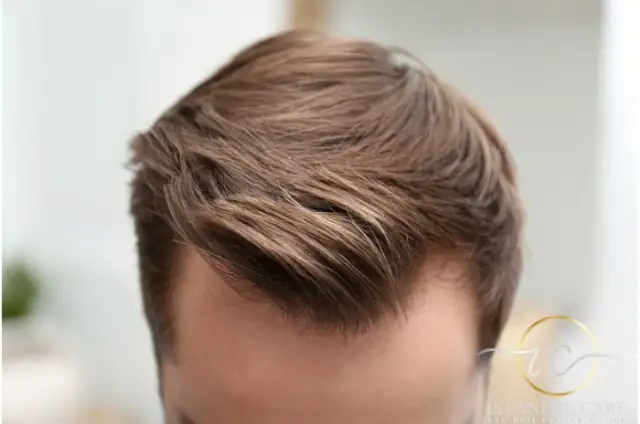 Close-up of a dense, restored front hairline