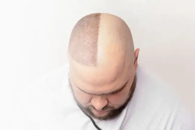 Shaved scalp with a newly implanted hairline