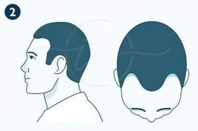 Illustration of an early receding hairline at Norwood stage 2