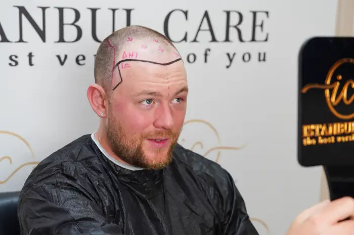 An unidentified man in a clinic cape with a shaved head and a planned hairline drawn on the scalp in marker, seated before a procedure.