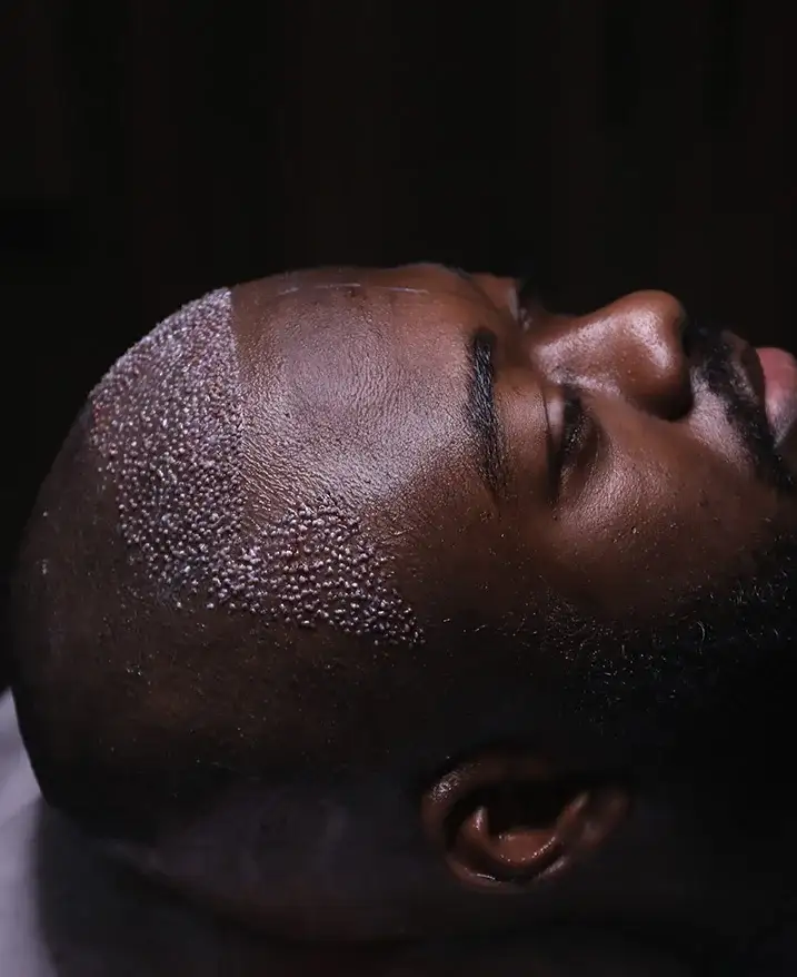 Close-up side view of an unidentified patient's closely shaved scalp immediately after a session, with placed grafts covering the front and temple area up to a clear boundary line.