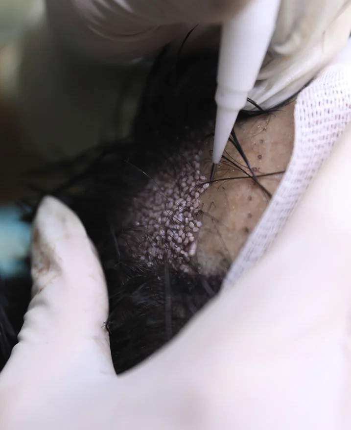 An implanter pen held in a gloved hand placing a single graft into the scalp of an unidentified patient, with placed grafts visible around it.