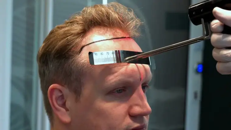 Línea capilar medida en la consulta