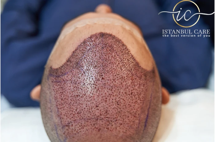 Clinica trapianto capelli Albania: come scegliere