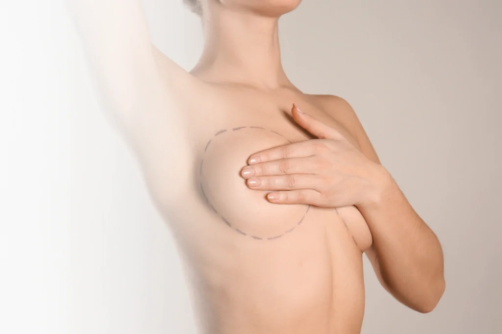 Breast Lift Surgery in Turkey - Istanbul Care