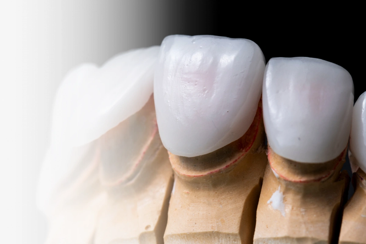 E-max Veneers  Dental in Turkey