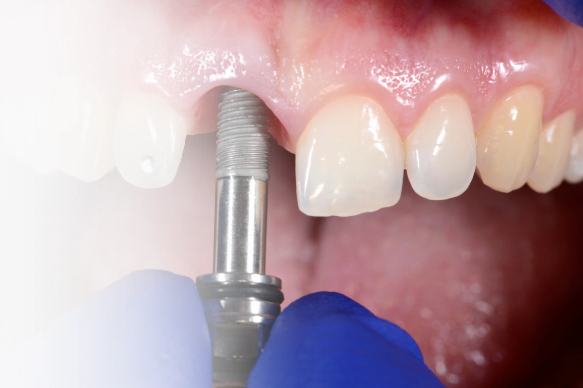 Implant Treatment in Turkey